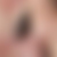 Lentigo-maligna-Melanom (Detailaufnahme): seit mehreren Jahren bekannter, langsam wachsender, zun...