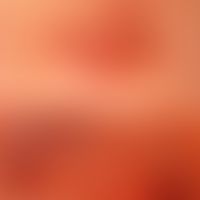 Amelanotic lentigo maligna melanoma: regressive originally coherent brown plaque, dissected by de...