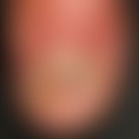 Melanoma, malignant, acrolentiginous. solitary, chronically stationary, slowly increasing, locali...