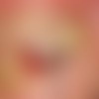 Melanoma, malignant, acrolentiginous. solitary, chronically stationary, slowly increasing, locali...