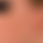 melanodermatitis toxica. chronic stationary (no growth dynamics), large, blurred, symptomless (on...