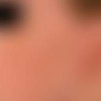 melanodermatitis toxica. chronic stationary (no growth dynamics), large, blurred, symptomless (on...