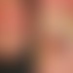 Melanom, malignes, akrolentiginöses. Solitäres, chronisch stationäres, langsam zunehmendes, an de...