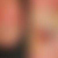 Melanoma, malignant, acrolentiginous. solitary, chronically stationary, slowly increasing, locali...