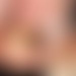 DD: Melanom malignes akrolentiginösesMelanom; hier: komplizierende&nbsp;Onychomykose mit Einblutu...