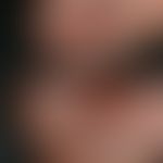 DD: Akrolentiginöses malignes Melanom: hier: Melanonychia longitudinalis: streifige durch einen i...