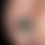DD. akrolentiginöses malignes Melanom:&nbsp;hier Nagelhämatom. Seit exakt 6 Wochen bestehende (Tr...
