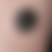 Melanoma, malignant, nodular, " always present", solitary, asymptomatic, growing for more than a ...