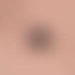 Melanoma, malignant, nodular. Malignant melanoma of the primary nodular type. Over the last few m...