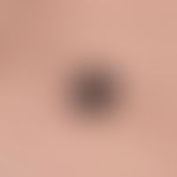 Melanoma, malignant, nodular. Malignant melanoma of the primary nodular type. Over the last few m...