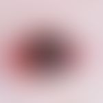 Melanoma, malignant, nodular. dark pigmented, superficially eroded brown-black nodule on reddish ...