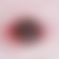 Melanoma, malignant, nodular. dark pigmented, superficially eroded brown-black nodule on reddish ...