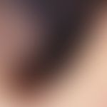 Melanom, malignes, superfiziell spreitendes. Auflichtmikroskopie: Inhomogene, schwarz-gräulich-bl...