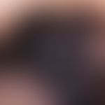 Melanom, malignes, superfiziell spreitendes. Auflichtmikroskopie, Detailvergrößerung: Distinktes,...