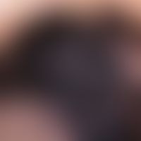 Melanom, malignes, superfiziell spreitendes. Auflichtmikroskopie, Detailvergrößerung: Distinktes,...
