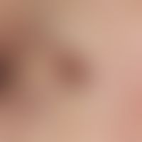 Lentigo solaris. solitary, chronically stationary, 0.8 x 0.6 cm large, sharply defined, inhomogen...