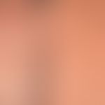 Transitorische akantholytische Dermatose (M.Grover): seit wenigen Wochen bestehendes,&nbsp;mäßig ...