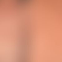 Transitory acantholytic dermatosis (M.Grover): moderately itchy clinical picture with disseminate...