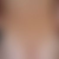 Eczema atopic: severe, generalized, severely itchy atopic eczema existing since earliest childhoo...