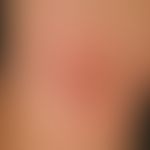 flexural atopic eczema. skin changes in an 18-year-old girl with intermittent course since the ag...