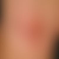 flexural atopic eczema. skin changes in an 18-year-old girl with intermittent course since the ag...