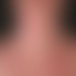 Eczema atopic (overview): severe atopic eczema existing for years, mainly flexural in adolescence...