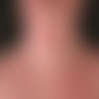 Atopische Dermatitis&nbsp;(Übersicht): seit Jahren bestehendes, in der Jugendzeit überwiegend beu...
