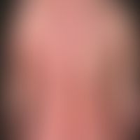 Atopische Dernmatitis&nbsp;(1 -Ausgangsbefund): schwere, universelle&nbsp;(erythrodermische) atop...