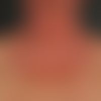 Atopische&nbsp;Dermatitis photoaggravierte: 72-Jahre alte Patientin mit einer&nbsp;bekannten, wen...