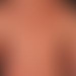 Eczema atopic (overview): severe atopic eczema existing for years, mainly localized in the adoles...