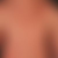 Eczema atopic (overview): severe atopic eczema existing for years, mainly localized in the adoles...