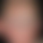 Eczema atopic in infancy: Acutely exacerbated and pyodermized atopic eczema; positive atopic FA i...
