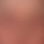 Eczema, atopic. pronounced symmetrical infestation of the eyelids. massive permanent itching; kno...