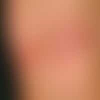 flexural atopic eczema. skin lesions in a 13-year-old girl with intermittent course since the age...