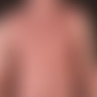 Eczema atopic (overview): severe, universal (erythrodermic) atopic eczema. exacerbation phase sin...
