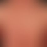 Eczema atopic (overview): severe atopic eczema existing for years, mainly flexural in the adolesc...