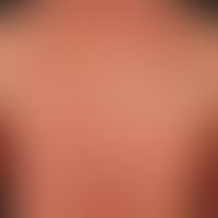 Eczema atopic (overview): severe atopic eczema existing for years, mainly flexural in the adolesc...