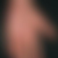 Atopische Dermatitis&nbsp;(Übersicht): Flächige Rötung der Handfläche. Hyperlinearität. Dissemini...
