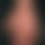 Eczema atopic (overview): flat eczematous infestation of the palms, hyperlinearity and lichenific...