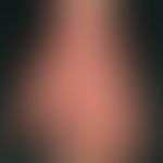 Eczema, atopic. chronic, red, blurred, large, severely itchy, rough plaques on lichenified skin. ...