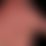 Eczema atopic (overview): relapsing-active, itchy, dyshidrotic eczema with numerous vesicles and ...