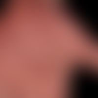 Atopische Dermatitis&nbsp;(Übersicht): schubaktives, juckendes,&nbsp;dyshidrotisches Ekzem mit za...