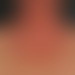 Eczema atopic photoaggravated: 72-year-old female patient with a known, less active, chronic atop...