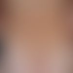 Ekzem atopisches im Kindesalter: 12-jähriger Jugendlicher mit generalisiertem atopischem Ekzem. A...