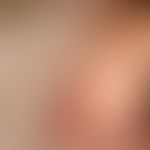Ekzem atopisches im Kindesalter: Impetiginisierte (Nachweis von Staphylokokkus aureus) chronische...