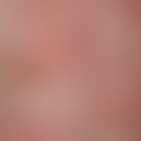Eczema atopic in child/adolescent: 12-year-old child; acute episode of the previously known atopi...