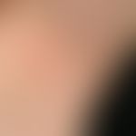 Beugebetontes atopisches Ekzem. Hautveränderungen bei einem 13-jährigen Mädchen. Positive atopisc...