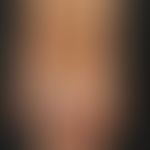 Ekzem atopisches im Kindesalter: 14-jähriger Jugendlicher mit generalisiertem atopischem Ekzem. A...