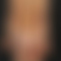 eczema atopic in childhood: 14-year-old adolescent with generalized atopic eczema. striking grey-...