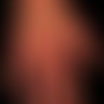 Granuloma anulare:&nbsp;ausgeprägte Knotenbildung seit mehreren Jahren bestehend. 54-Jahre alte a...